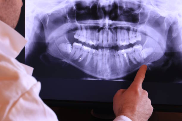 Emergency Dental Filling Replacement in MO