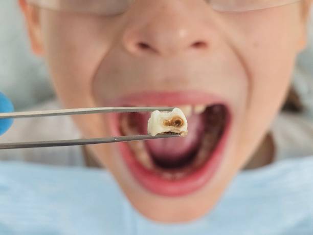Best Cracked Tooth Emergency Dentist  in Diand, MO